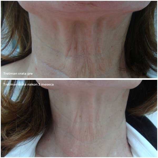 neck before and after cortex laser treatment