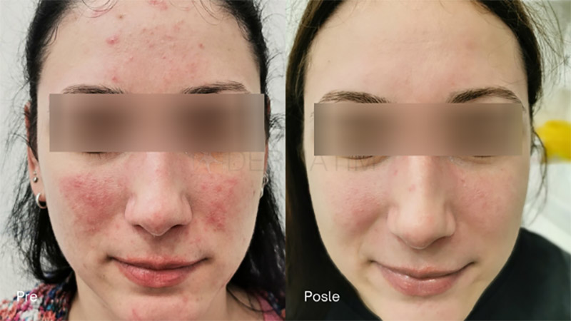 crvene fleke od akni