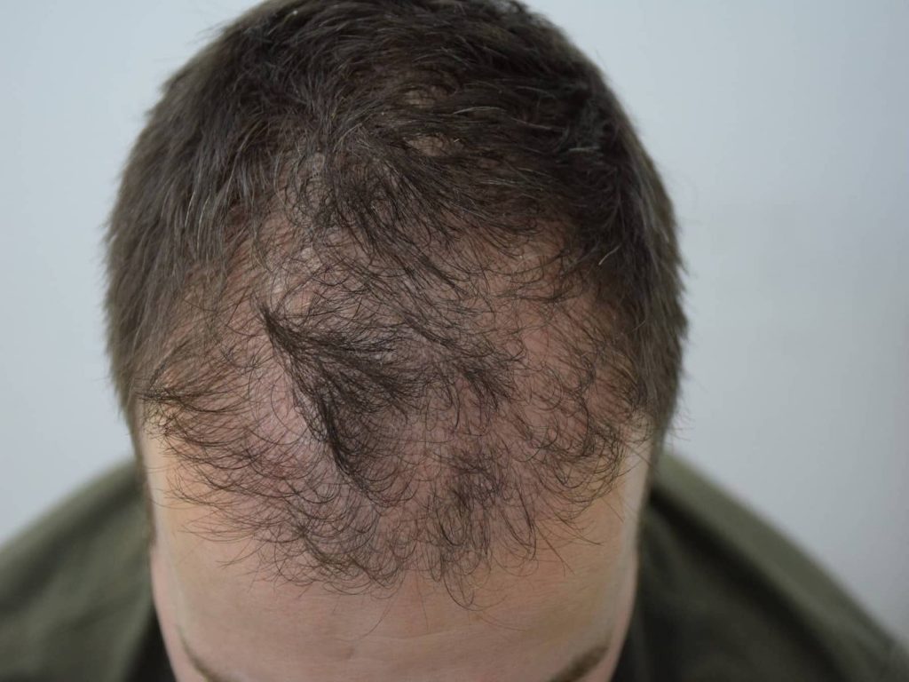 Alopecia of the scalp