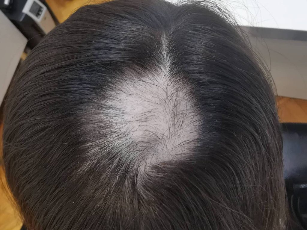 alopecija u kosi