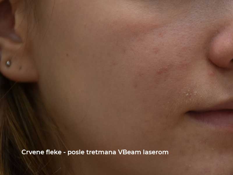 Post-acne erythema — Vbeam laser treatment