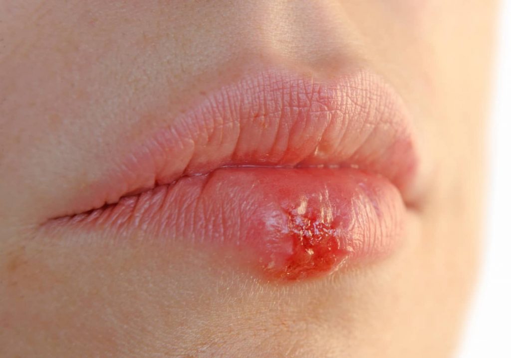 Herpes simplex on the lip