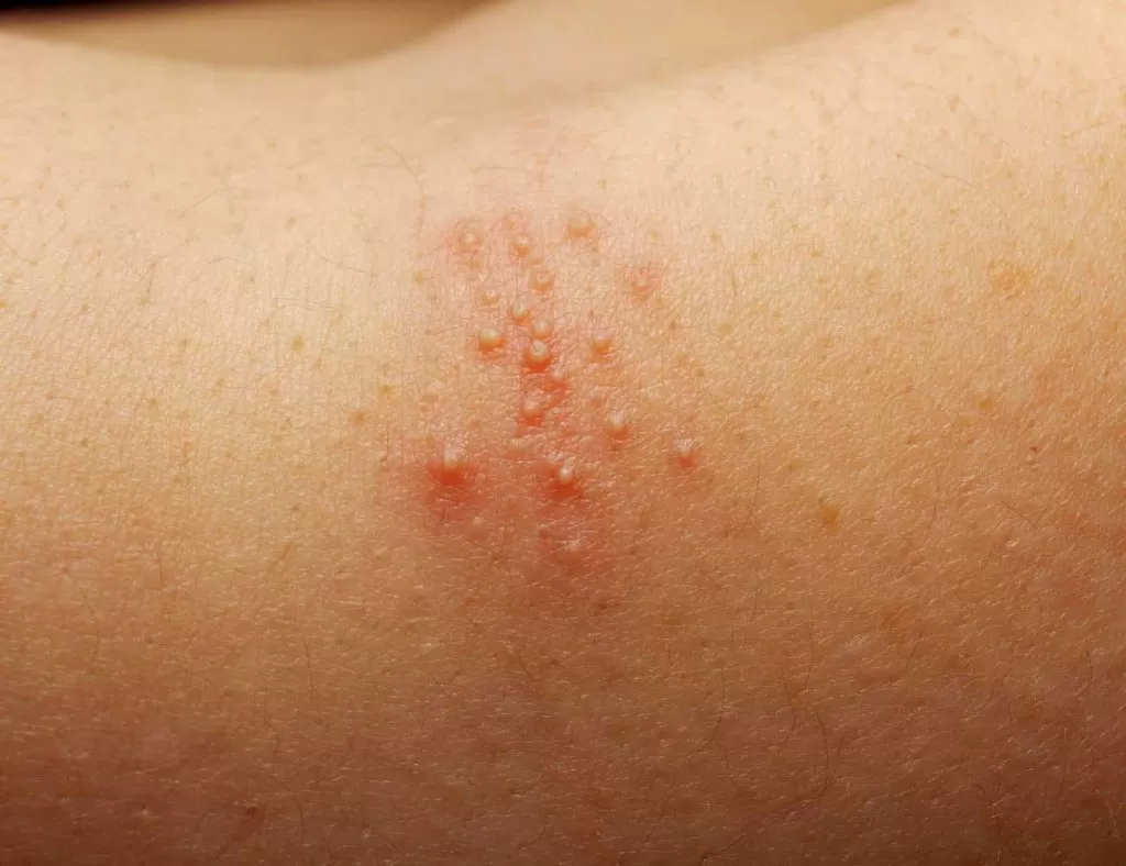 herpes zoster (shingles)