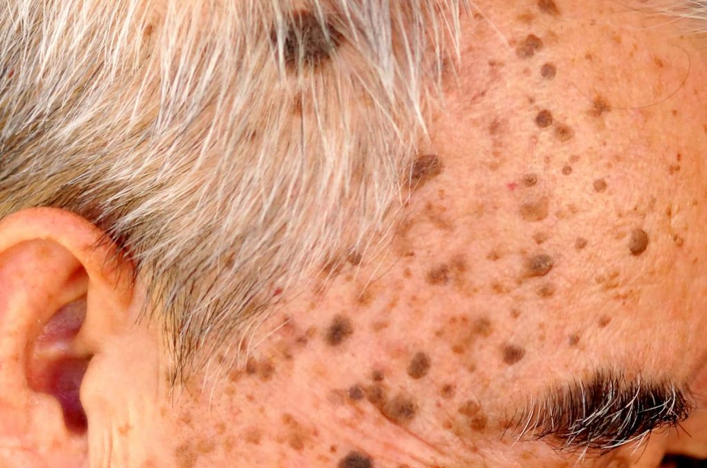 actinic keratosis face