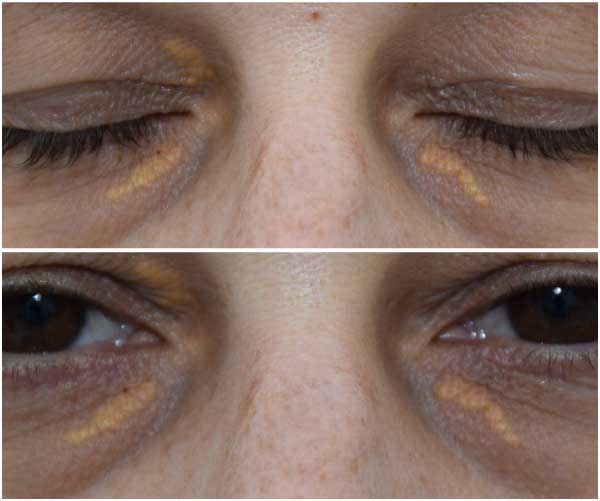 Xanthelasma Removal Xanthelasma Treatment Xanthelasma Under Eye 