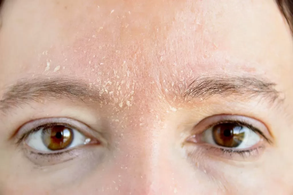 seborrheic dermatitis on the forehead