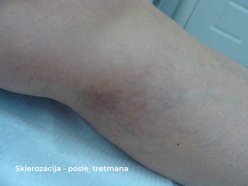 sclerotherapy after treatment