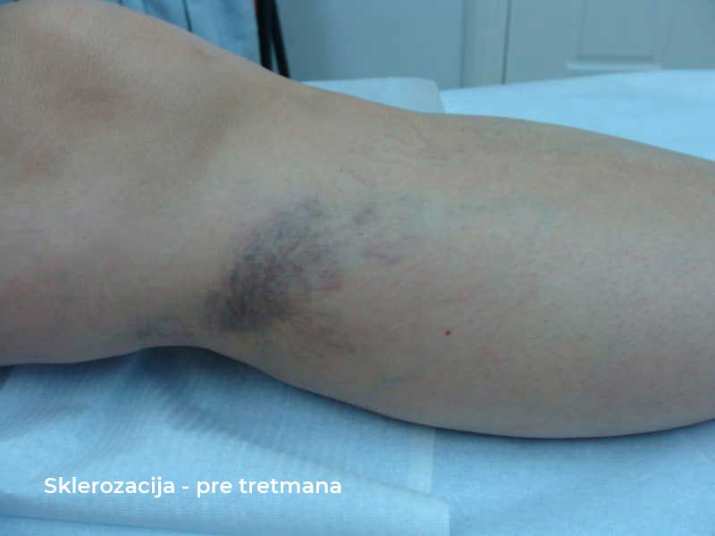 sclerotherapy before treatment