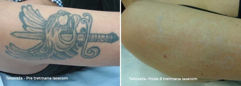 Removal of tattoos before and after laser treatment
