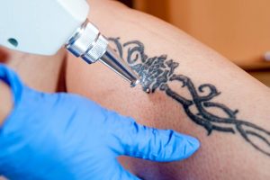 dermatim uklanjanje tetovaza