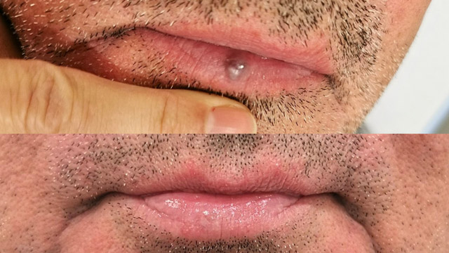 uklanjanje hemangioma