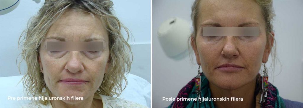 before after Hyaluronic acid fillers