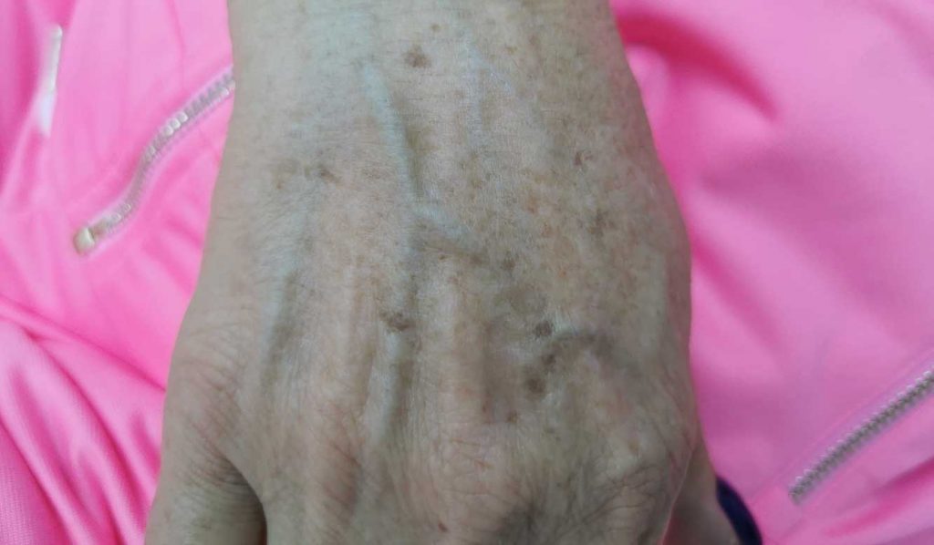 age spots on hand