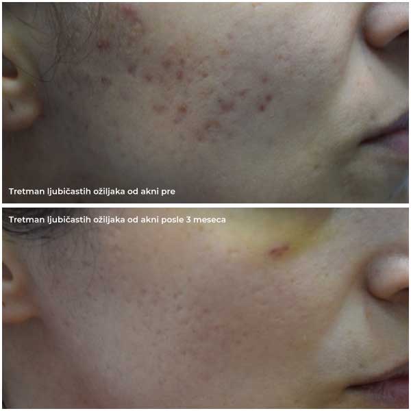 before the treatment of purple acne scars and 3 months after the treatment
