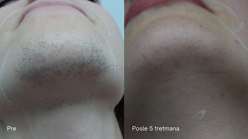 aleksandritni laser pre i posle