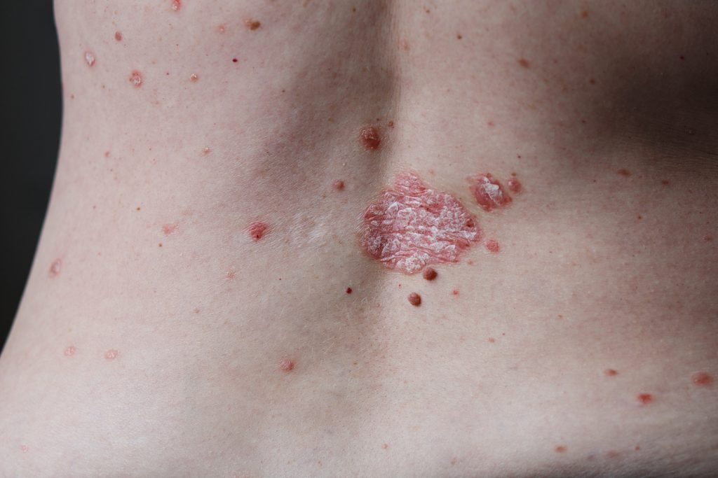 Skin - Atopic dermatitis