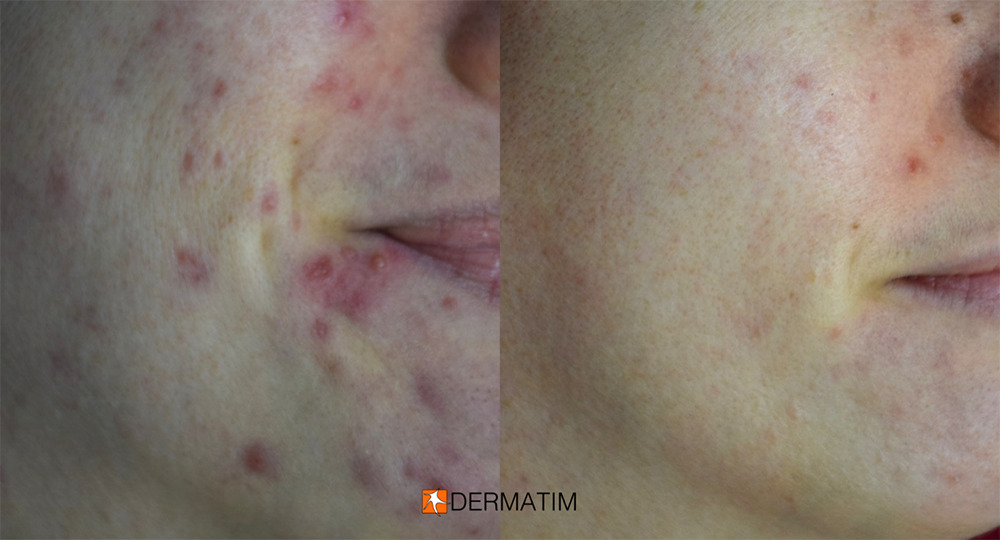 Acne treatment before after