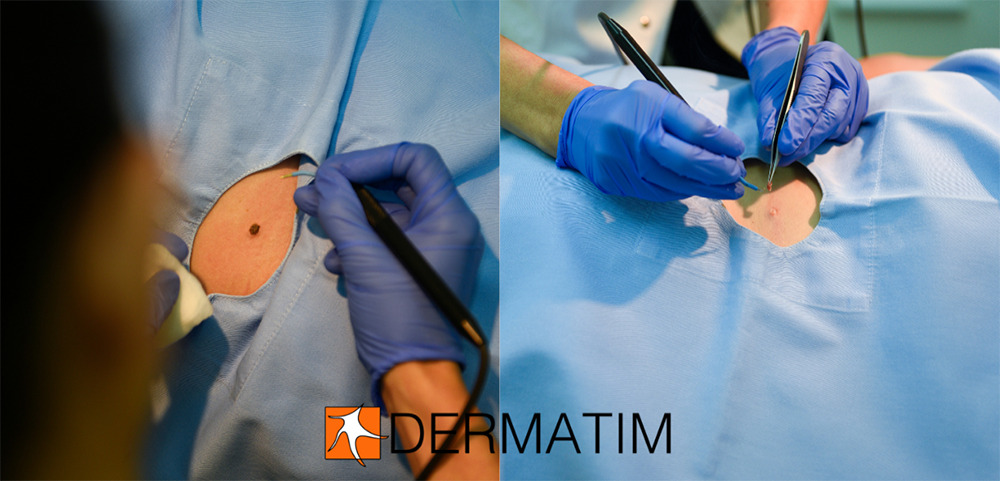 Radiofrequency mole removal belgrade dermatim