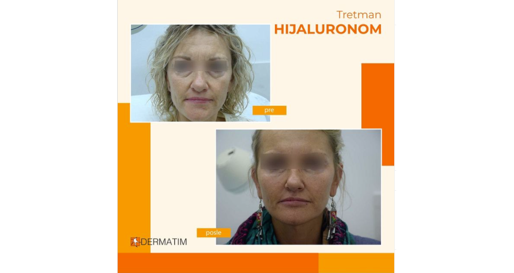Wrinkle removal with hyaluronic acid fillers