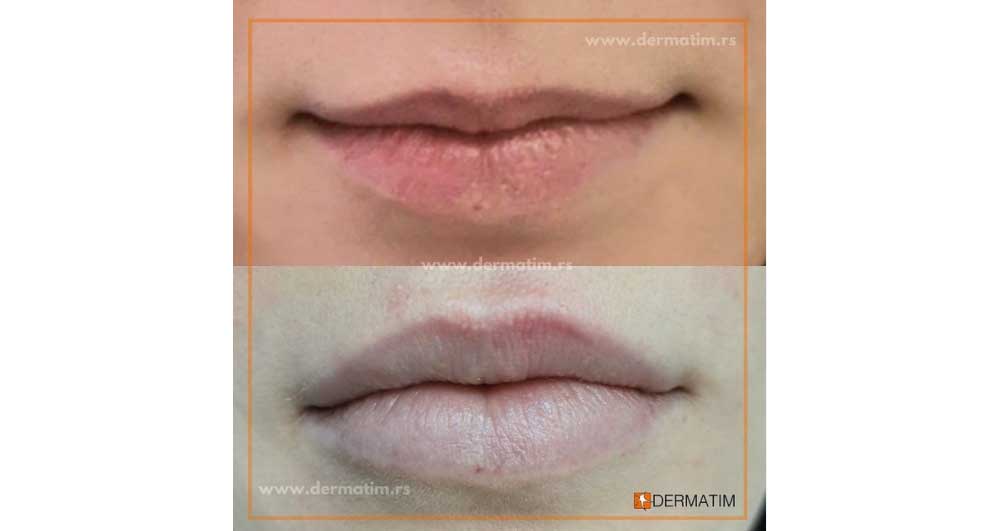 Lip-augmentation-and-correction