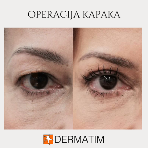 Eyelid surgery – Before and after