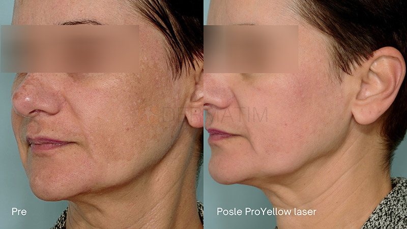 tretman Pro Yello laserom