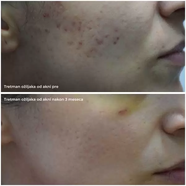 Acne scars treatment before and after