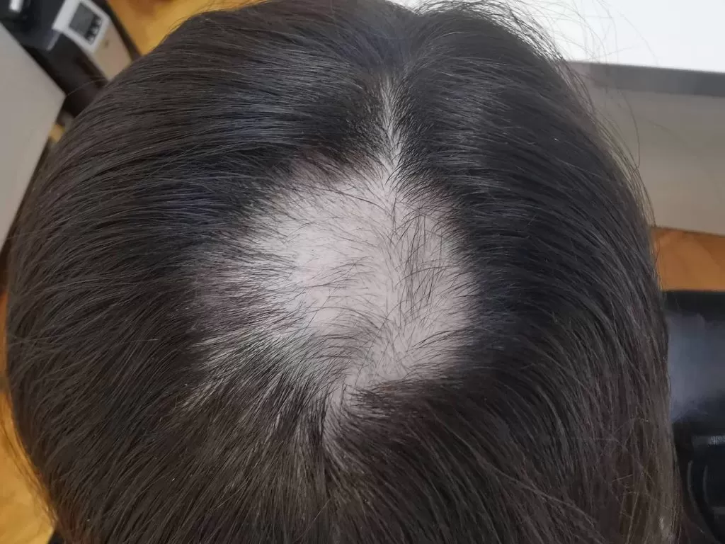 Alopecia of the scalp