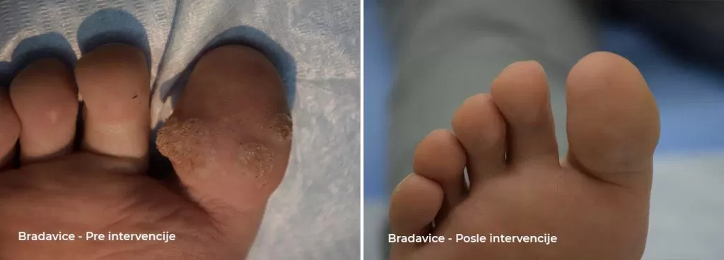 warts before and after the intervention