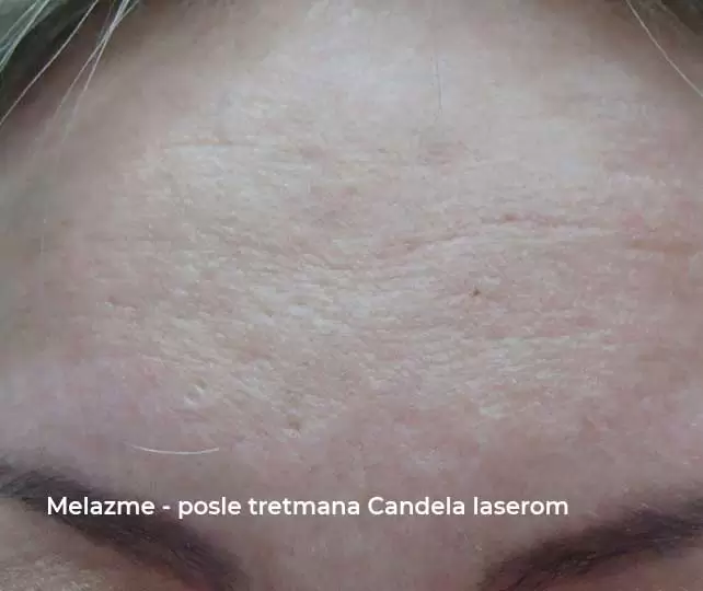 melasma after candela laser treatment