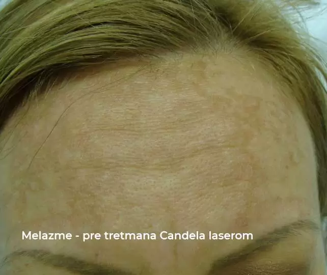 melasma before candela laser treatment