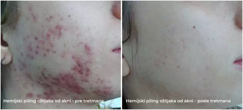 acne scar chemical peel before and after treatment