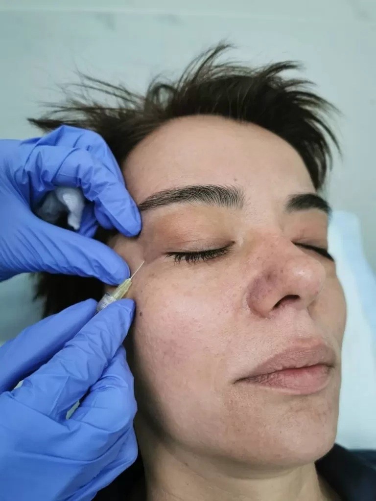 carboxytherapy
