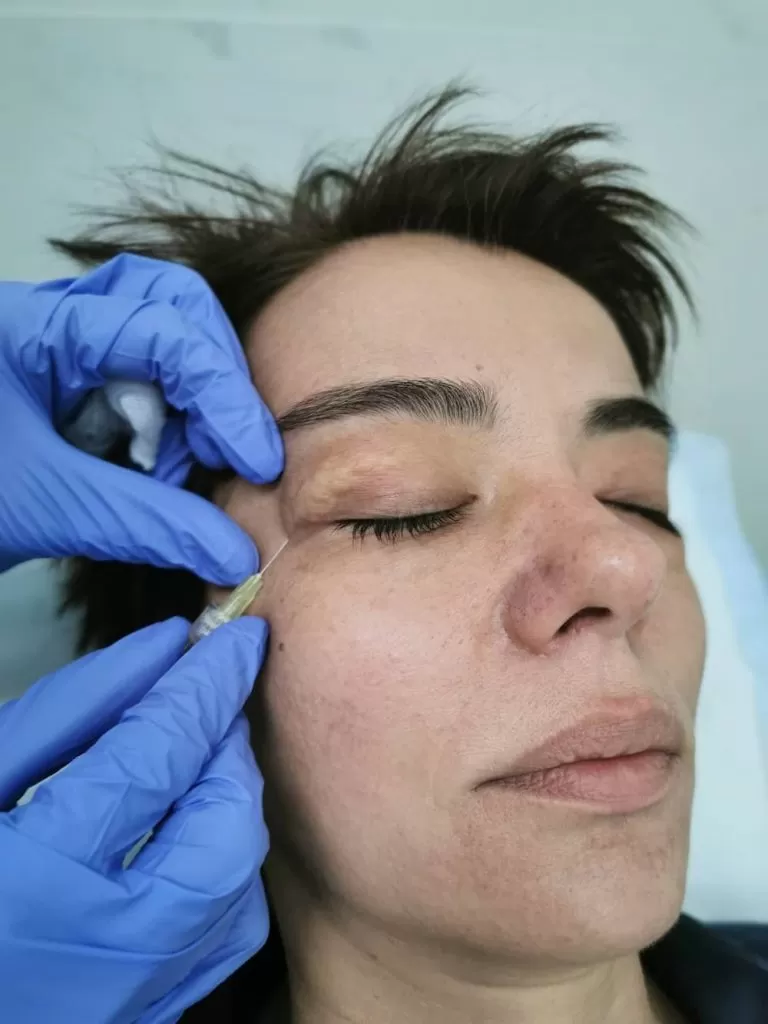 carboxytherapy