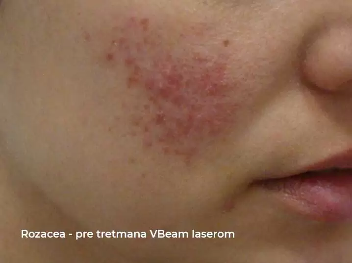 rosacea before vbeam laser treatment