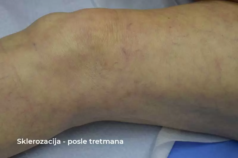 sclerotherapy after treatment