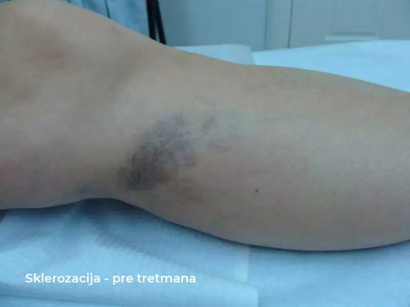 sclerotherapy before treatment