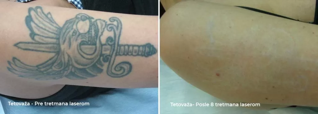 Tattoo Removal Laser | Laser Removal Tattoo | Tattoo Laser Removal