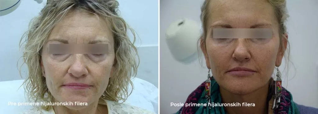 Hyaluronic acid filler treatment before after Hyaluronic acid fillers