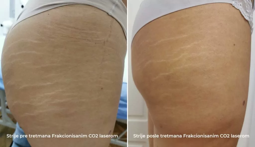stretch marks on the thighs