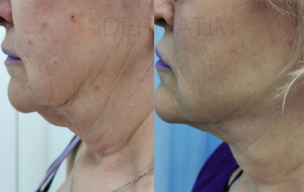 Renuvion treatment for loose and sagging skin