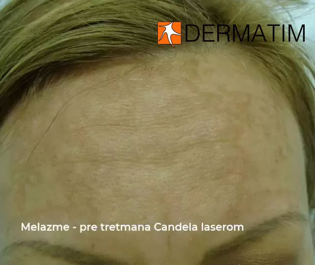 melazme pre tretmana candela laserom