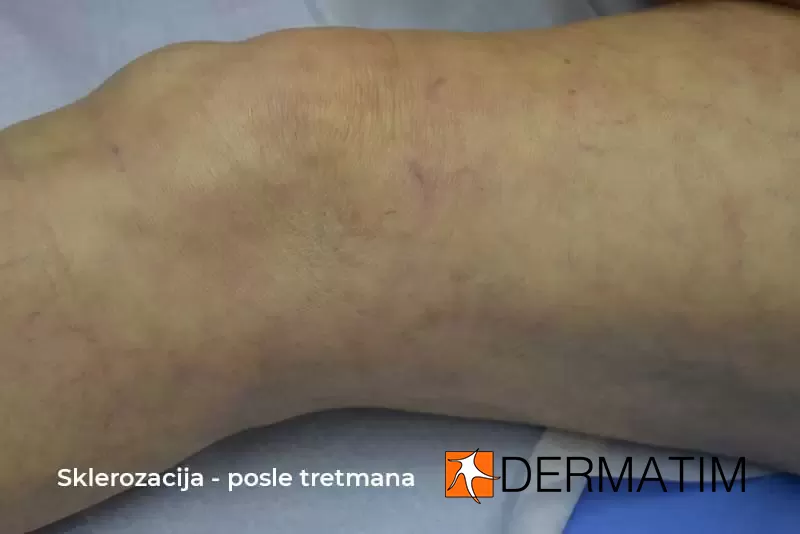 sklerozacija posle tretmana sklerozacija posle tretmana