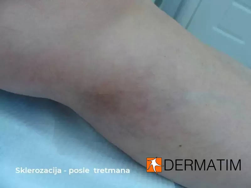 sklerozacija posle tretmana sklerozacija posle tretmana
