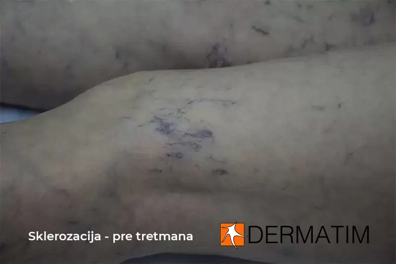 sklerozacija pre tretmana sklerozacija pre tretmana