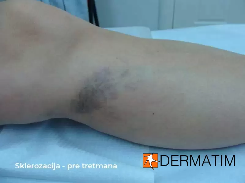 sklerozacija pre tretmana sklerozacija pre tretmana